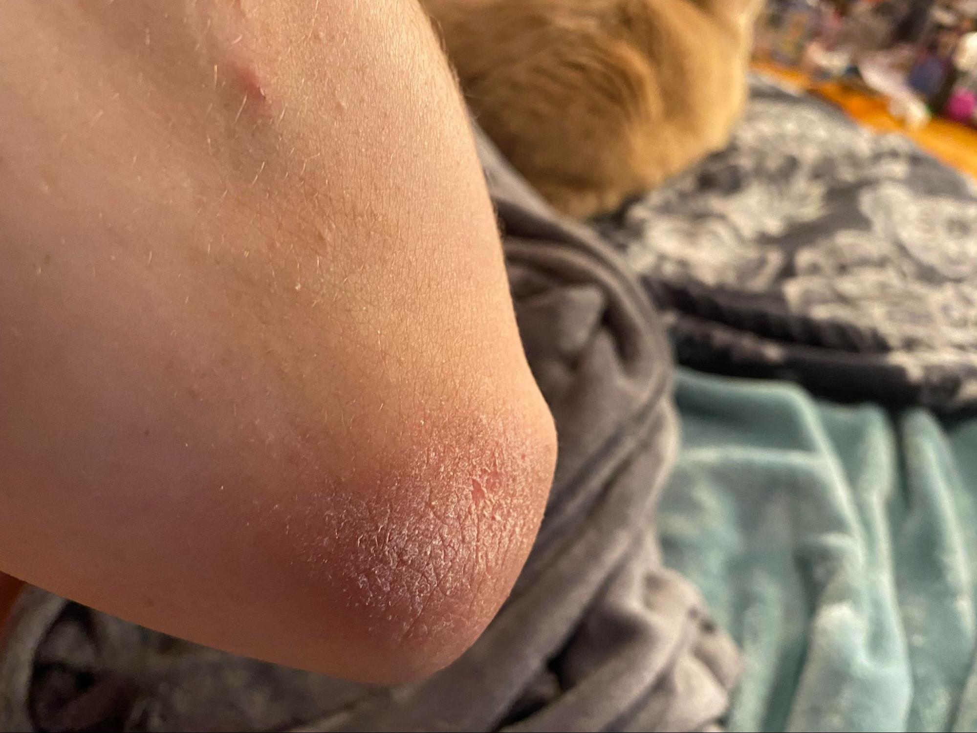 A close-up of dry, rough skin on an elbow