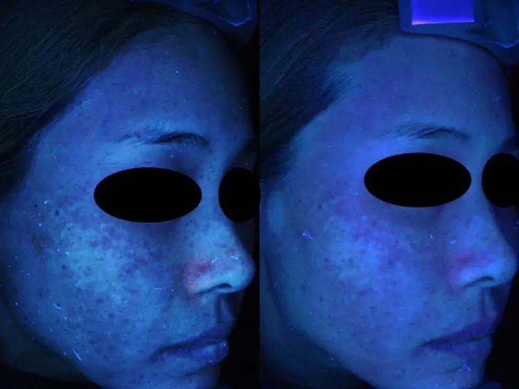 Before and after result 1 for Korean Peels
