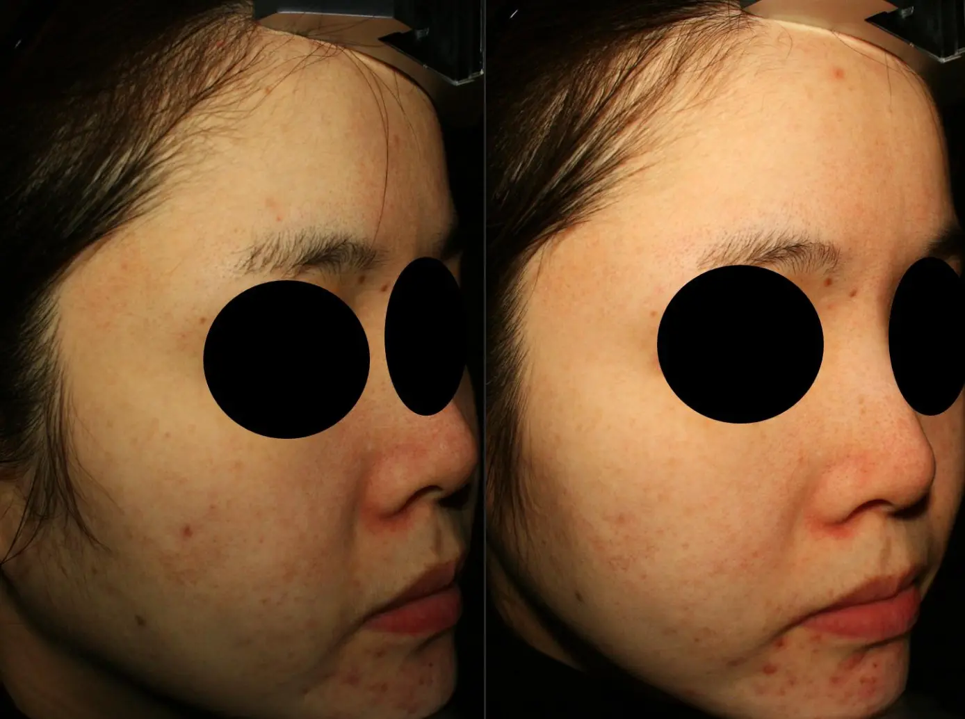 Before and after result 2 for Korean Peels