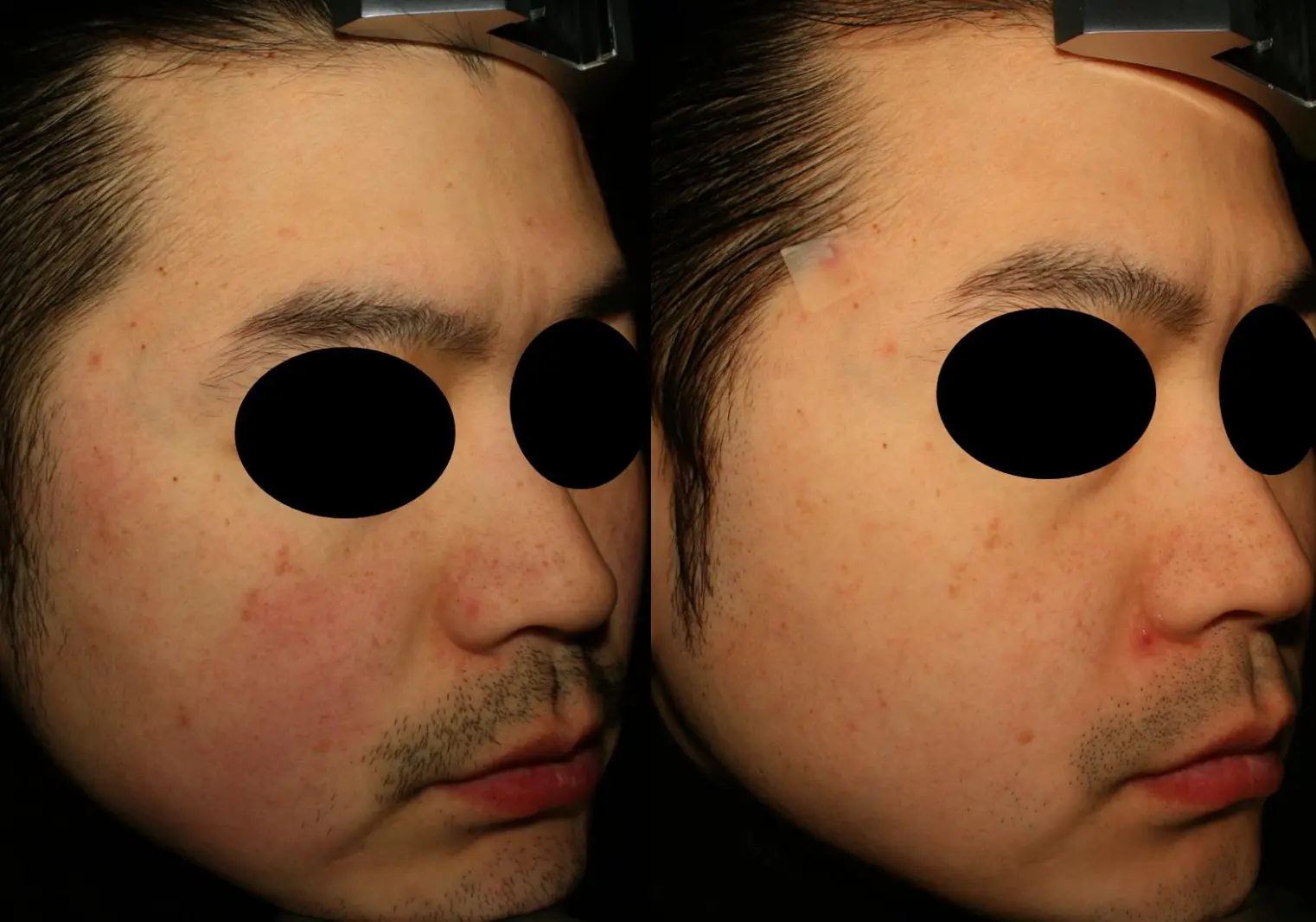 Before and after result 3 for Korean Peels