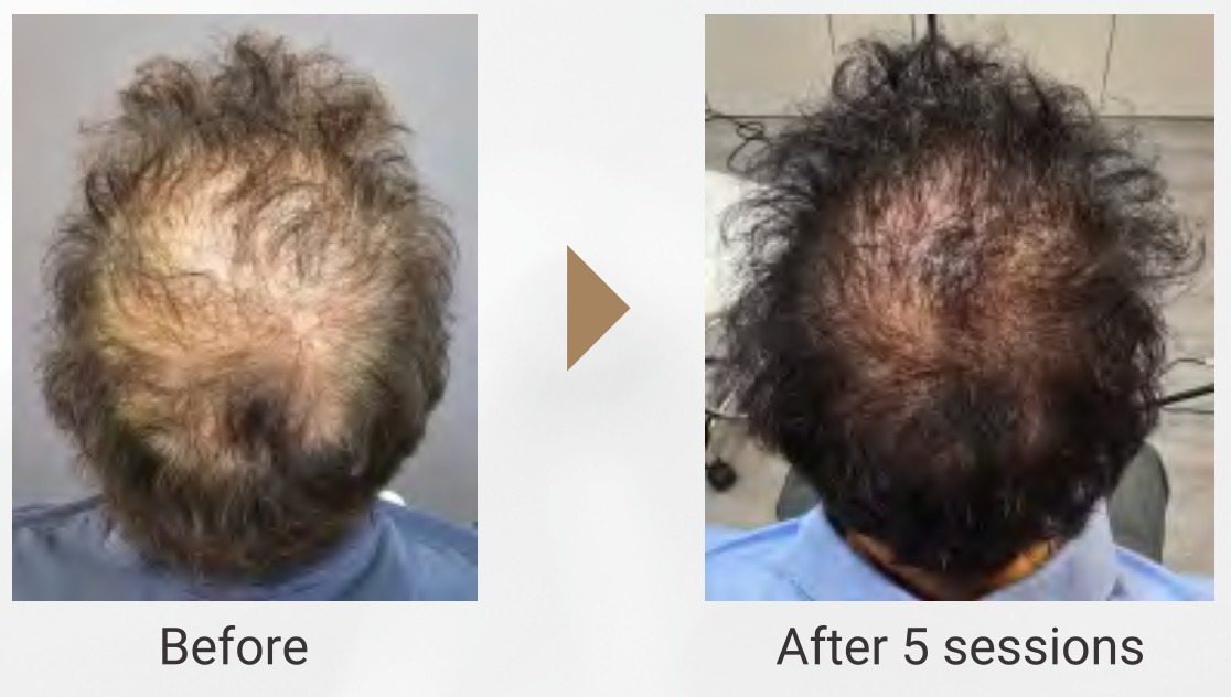 Result 1 for Exosome Hair Regeneration