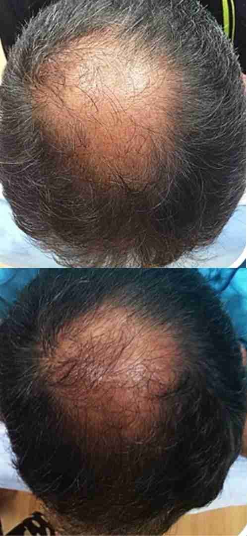 Result 1 for Hair Mesotherapy