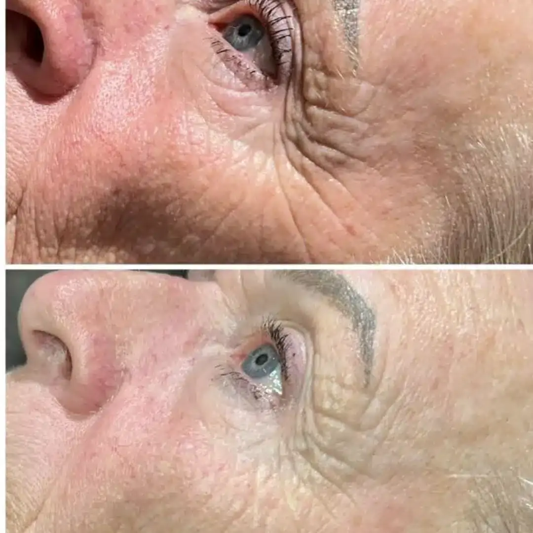 Before and after result 1 for Dermalux LED