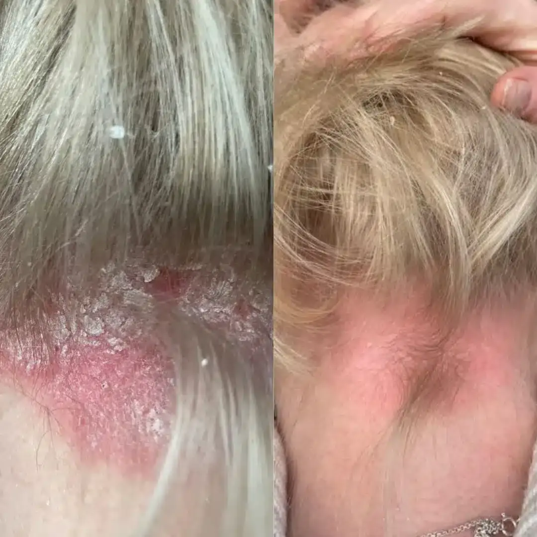 Before and after result 2 for Dermalux LED