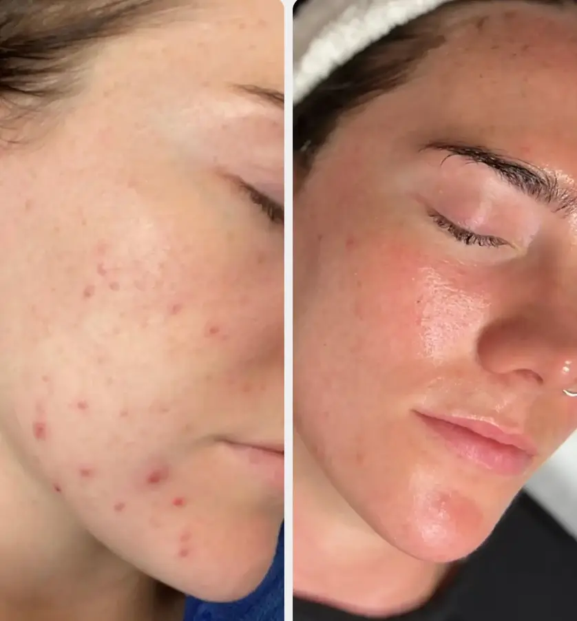 Before and after result 3 for Dermalux LED