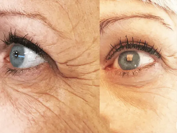 Before and after result 1 for Skin Boosters and Regeneratives