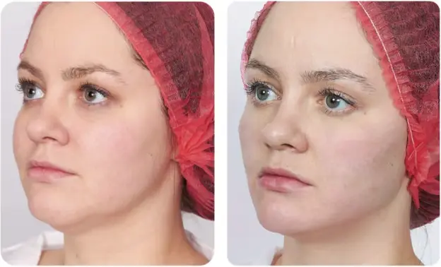 Before and after result 2 for Skin Boosters and Regeneratives