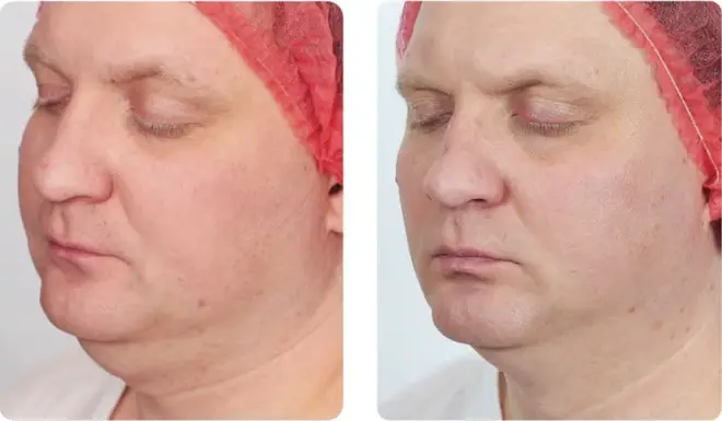 Before and after result 3 for Skin Boosters and Regeneratives