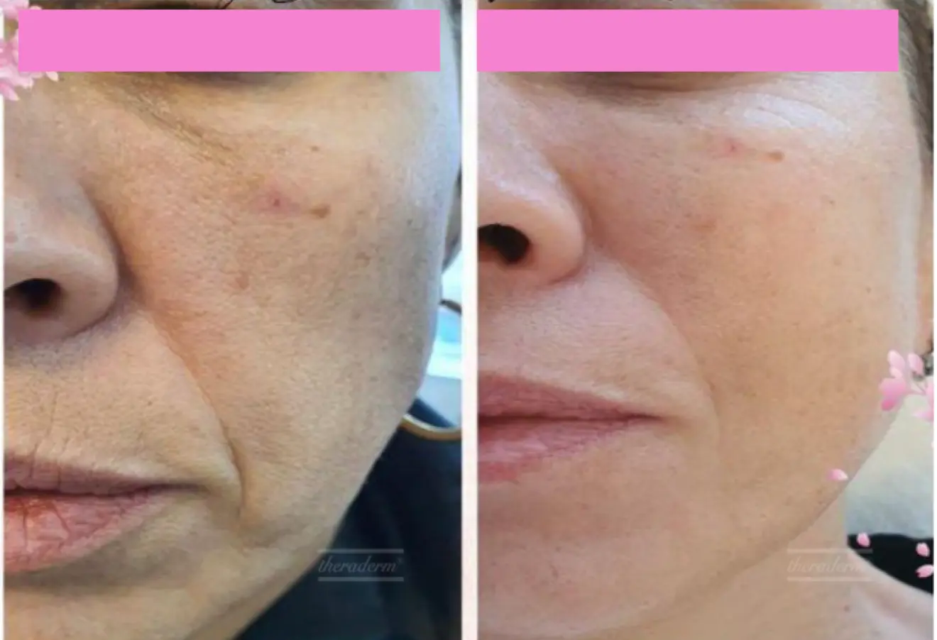 Before and after result 6 for Korean Peels