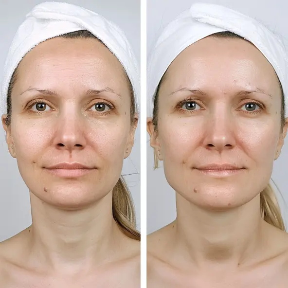 Before and after result 1 for Plinest