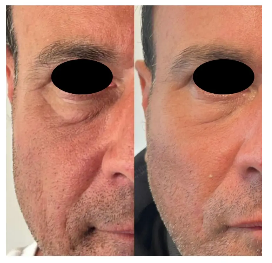 Before and after result 2 for Plinest