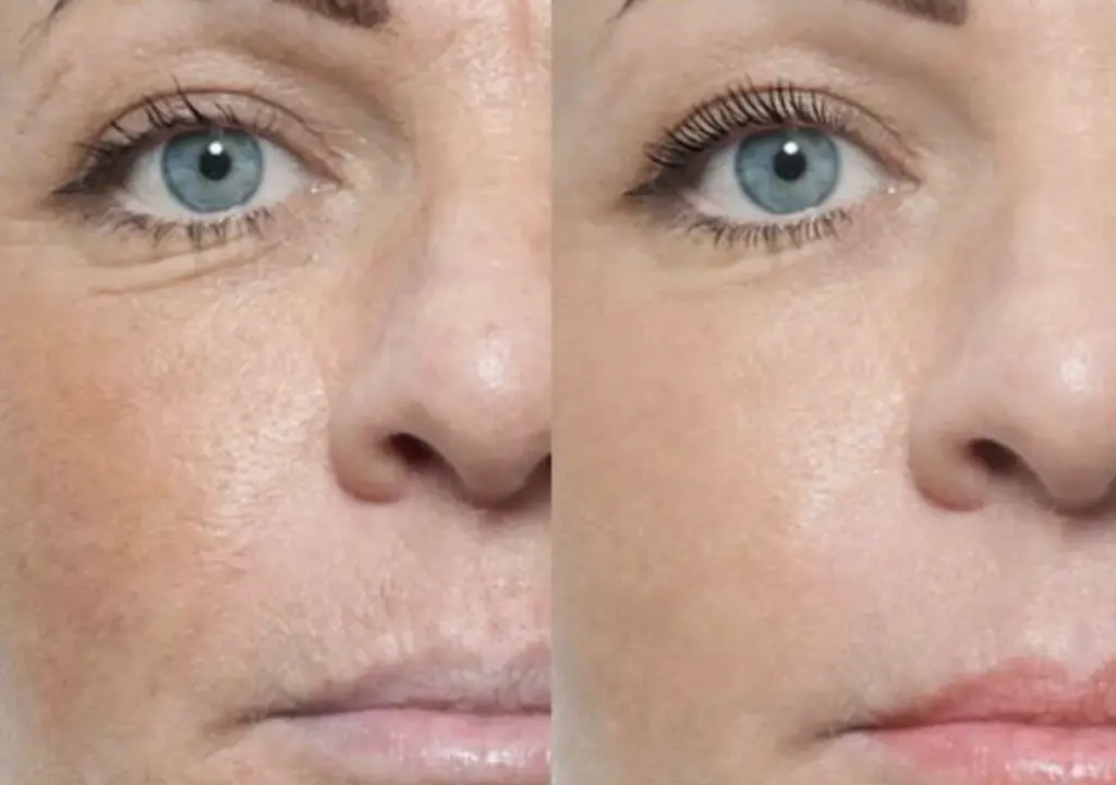 Before and after result 3 for Plinest