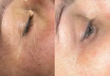 Before and after result 4 for Plinest