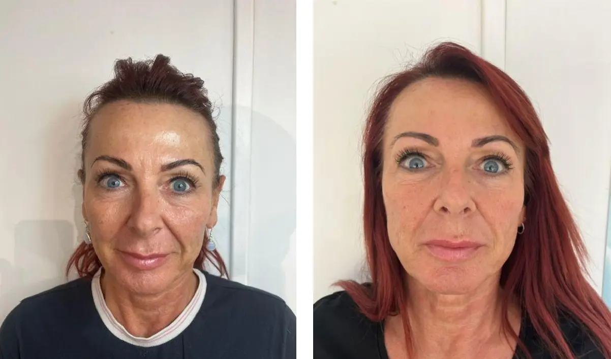 Before and after result 5 for Plinest