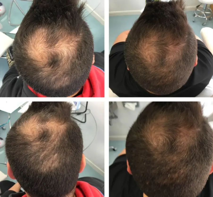 Before and after result 4 for Plinest Hair