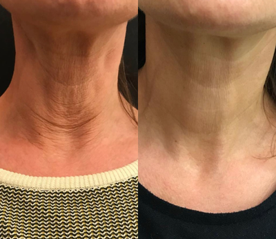 Before and after result 2 for Profhilo