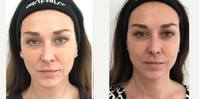 Before and after result 3 for Profhilo