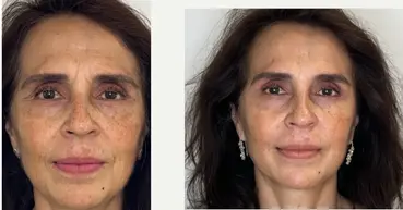 Before and after result 4 for Profhilo