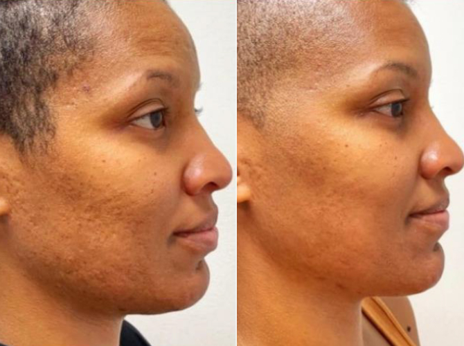 Before and after result 1 for Virtue RF