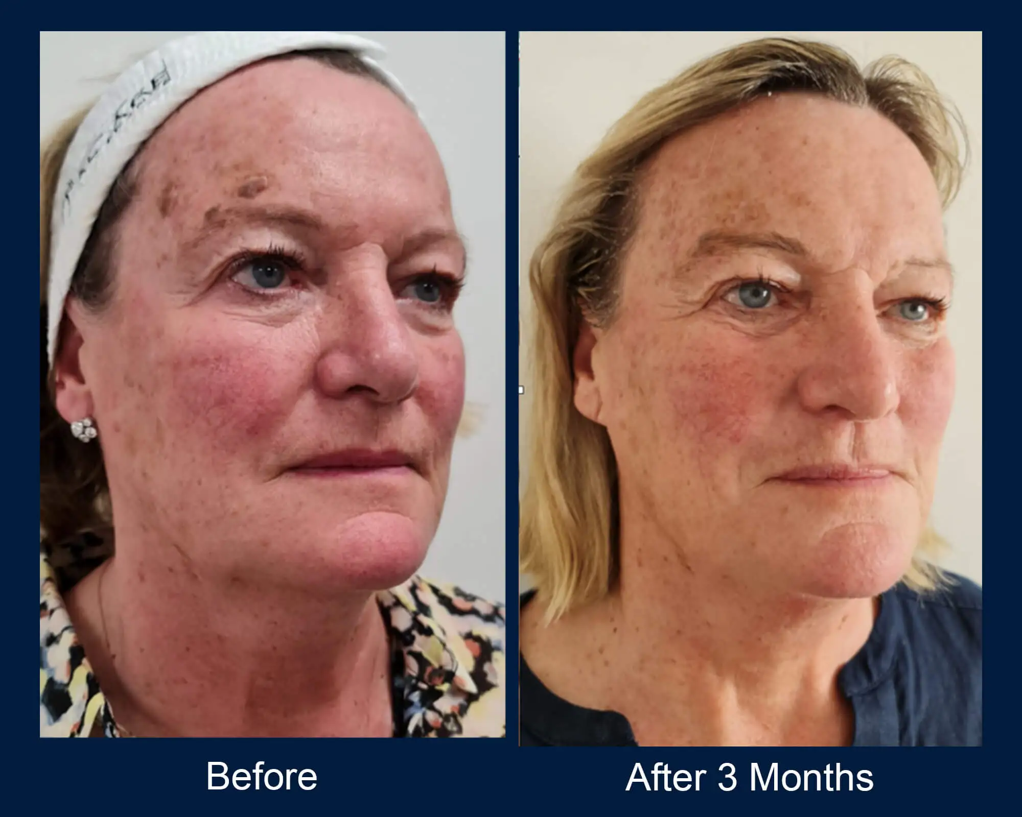 Before and after result 2 for Virtue RF