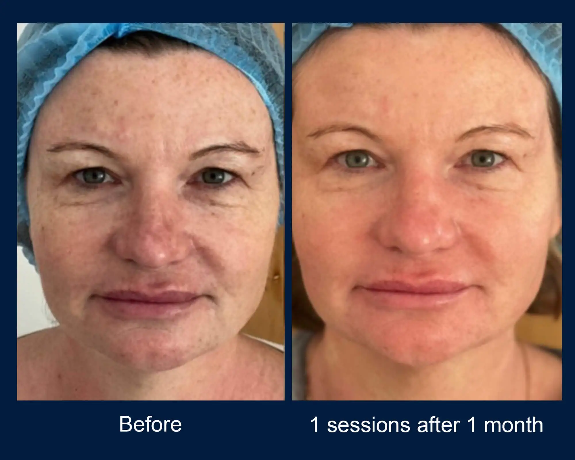 Before and after result 4 for Virtue RF