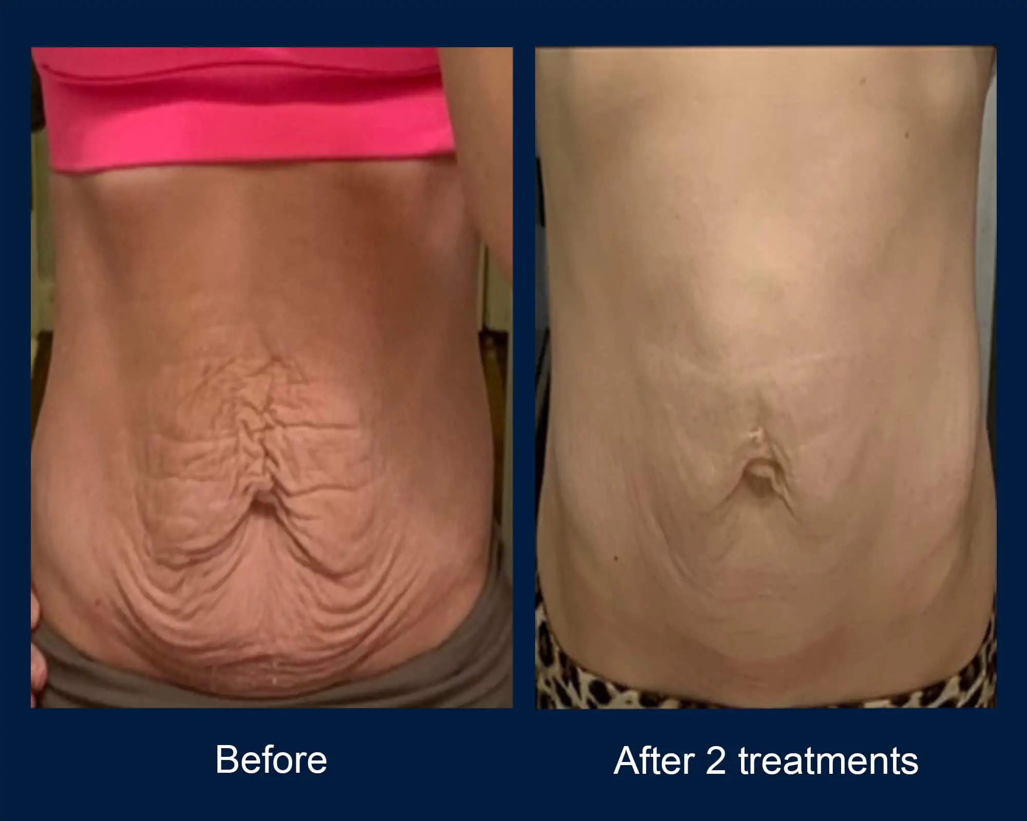 Before and after result 5 for Virtue RF