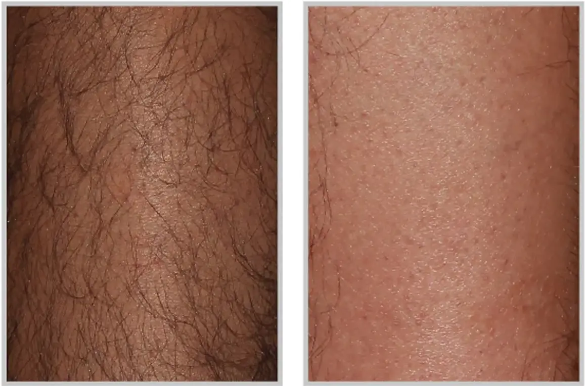 Before and after result 1 for Sciton BBL Forever Bare