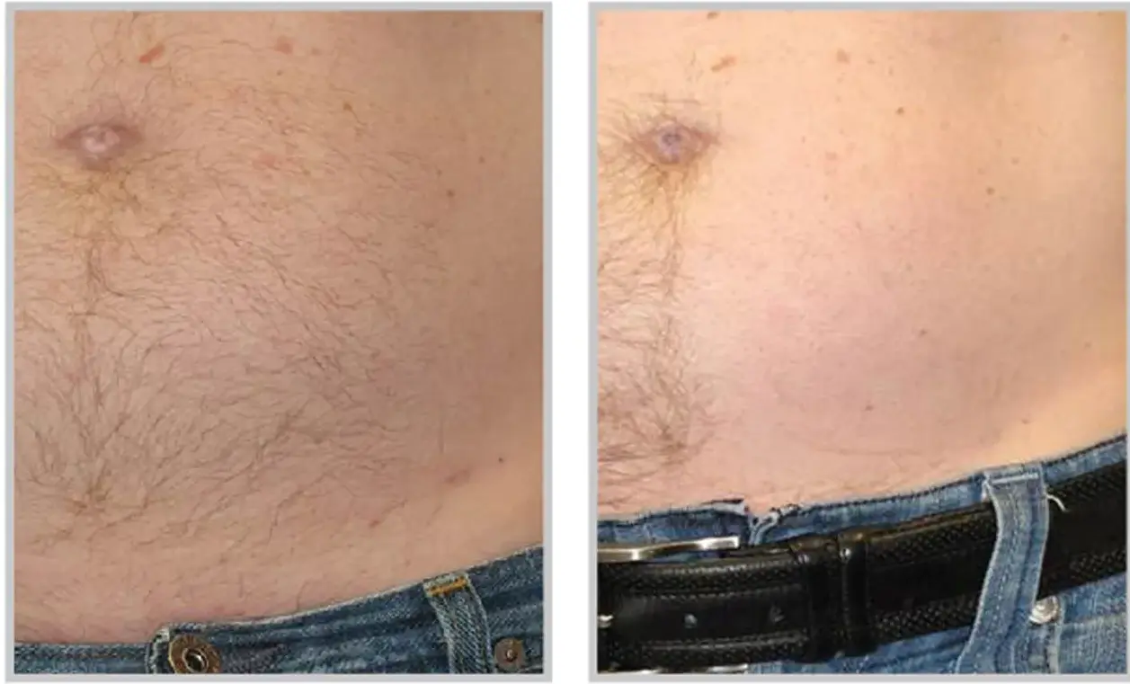 Before and after result 2 for Sciton BBL Forever Bare