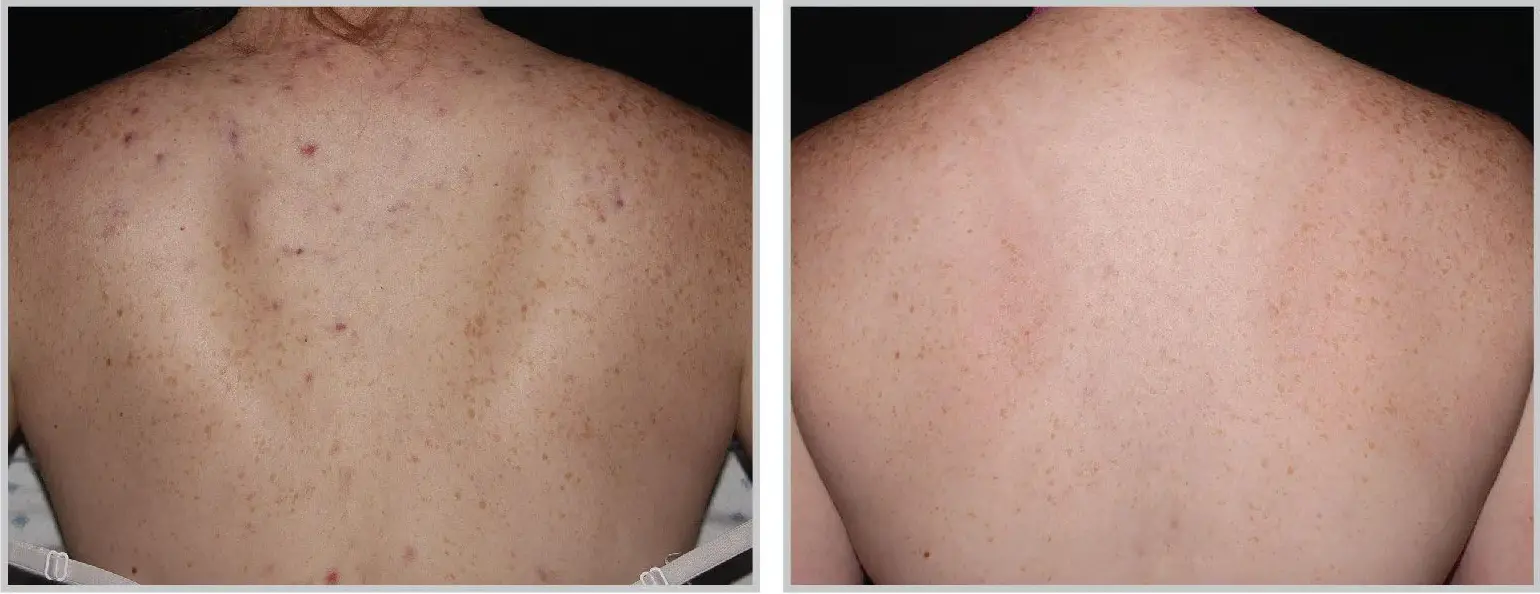 Before and after result 1 for Sciton BBL Forever Clear