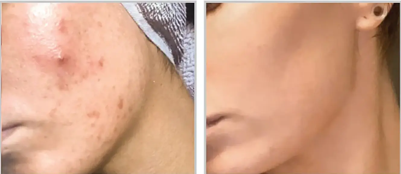 Before and after result 2 for Sciton BBL Forever Clear