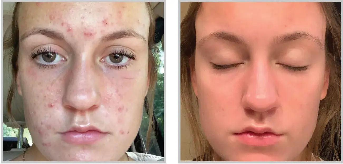 Before and after result 3 for Sciton BBL Forever Clear