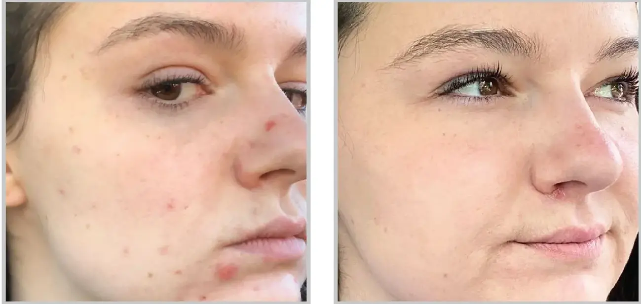 Before and after result 4 for Sciton BBL Forever Clear
