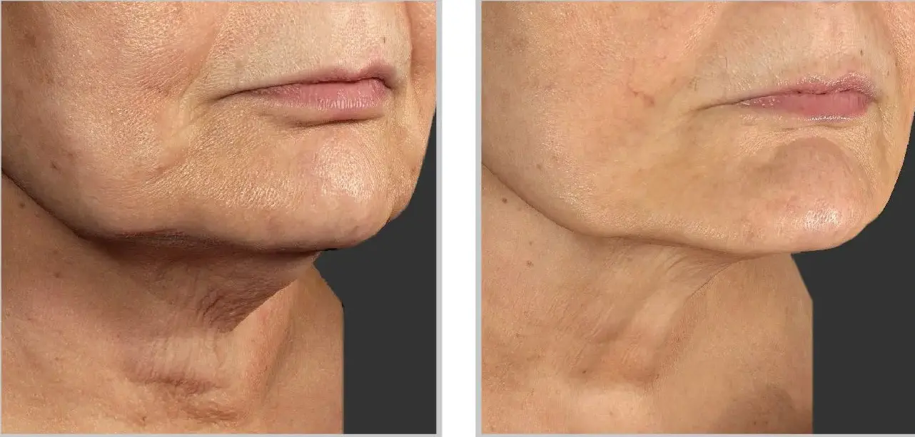 Before and after result 2 for Sciton BBL SkinTyte