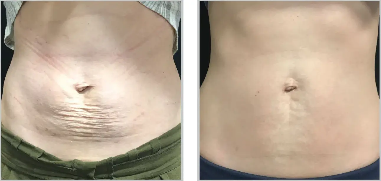 Before and after result 3 for Sciton BBL SkinTyte