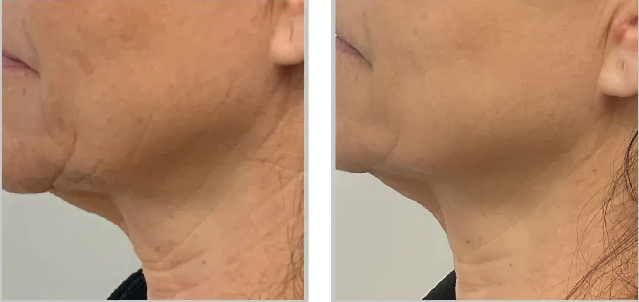 Before and after result 4 for Sciton BBL SkinTyte