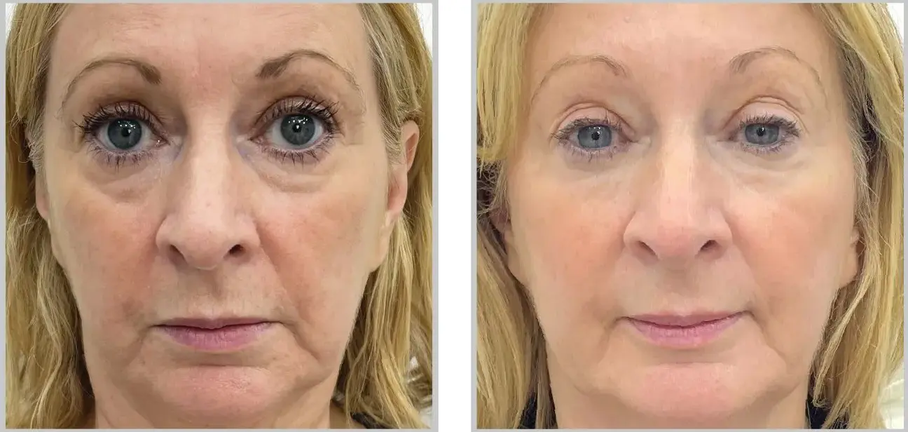 Before and after result 5 for Sciton BBL SkinTyte