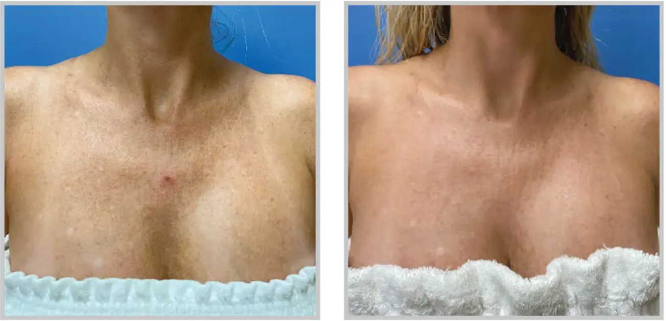 Before and after result 2 for Sciton Halo