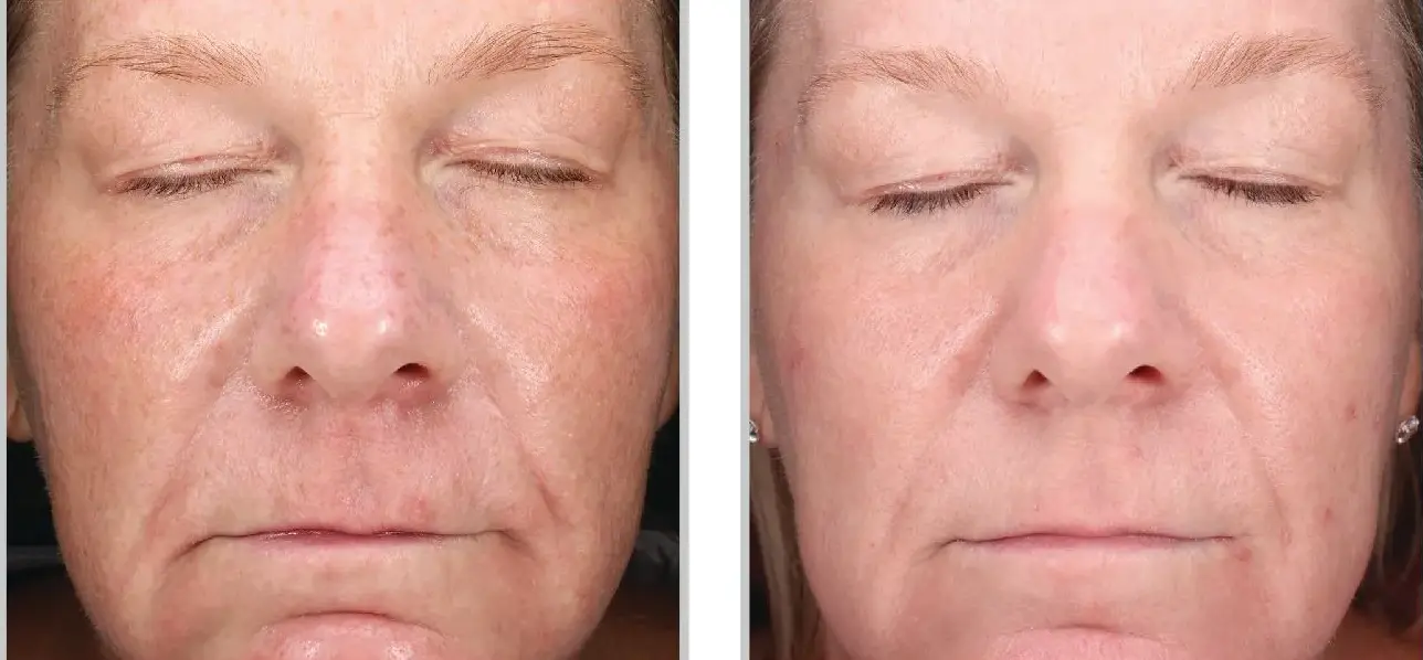 Before and after result 3 for Sciton Halo