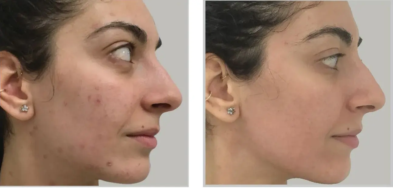 Before and after result 4 for Sciton Halo