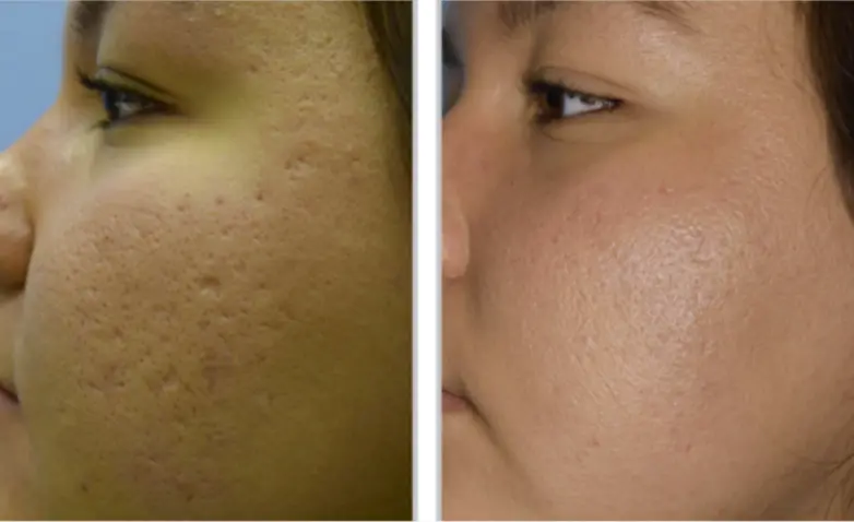 Before and after result 5 for Sciton Halo