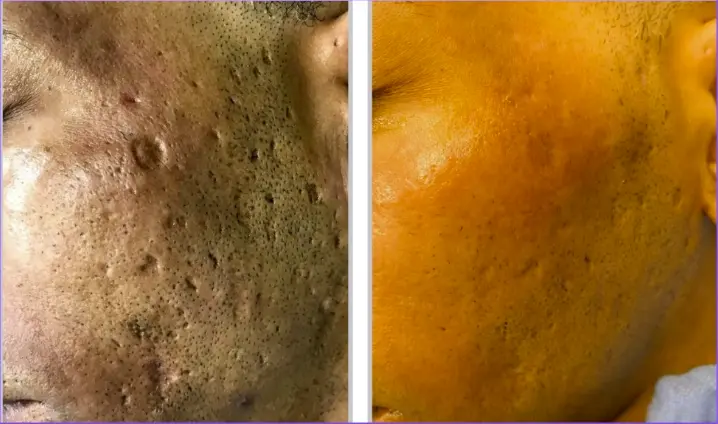 Before and after result 6 for Sciton Halo