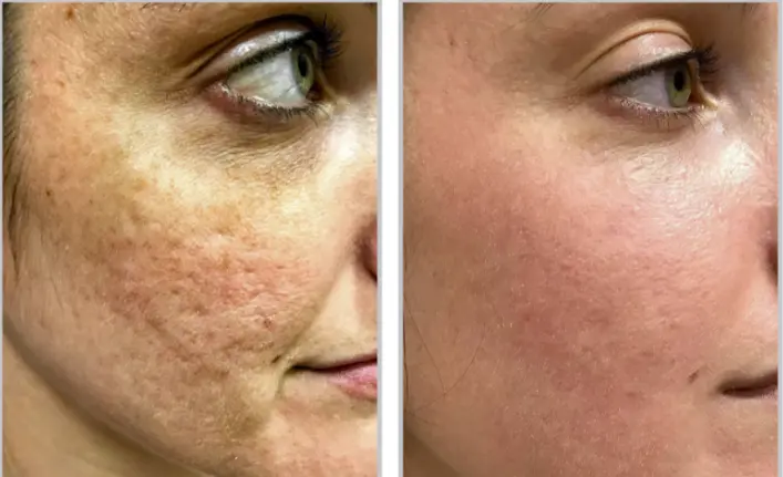 Before and after result 7 for Sciton Halo