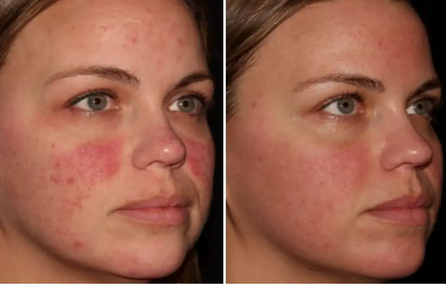Before and after result 8 for Sciton Halo