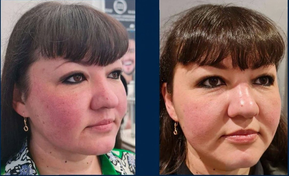 Before and after result 1 for Dermalux LED
