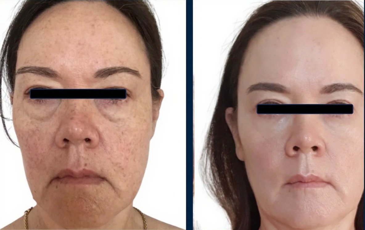 Before and after result 2 for Dermalux LED