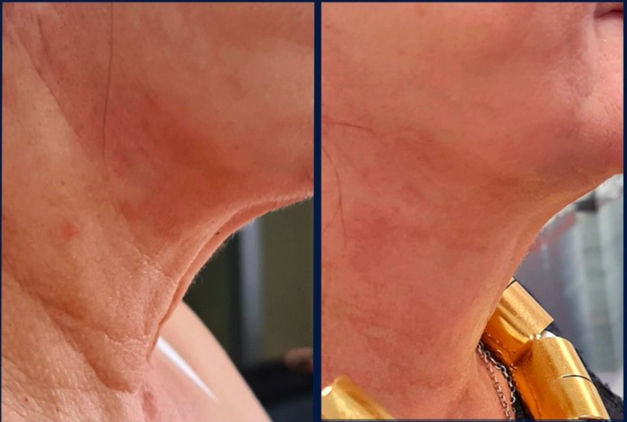 Before and after result 3 for Dermalux LED