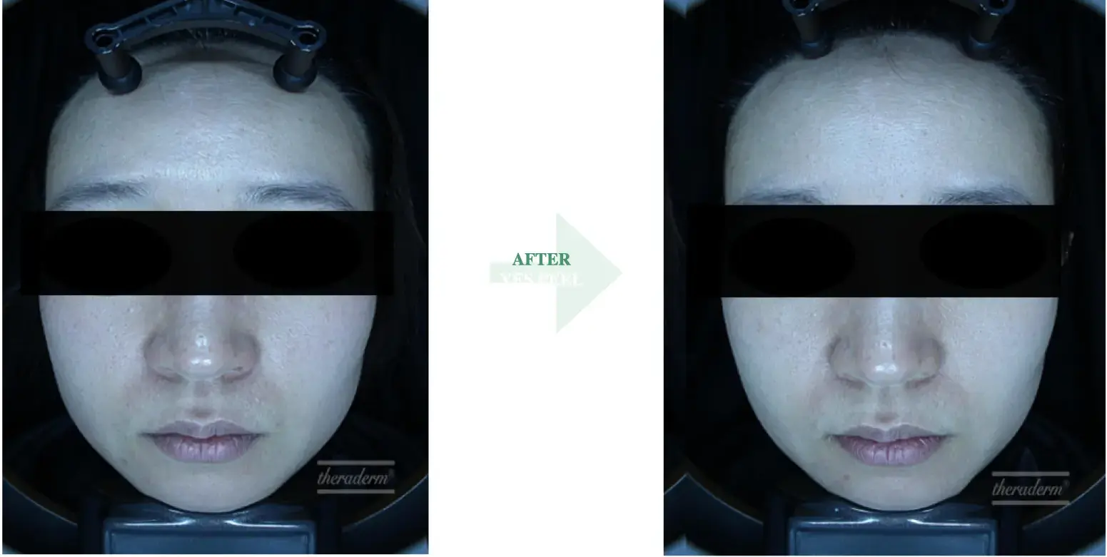Before and after result 7 for Korean Peels