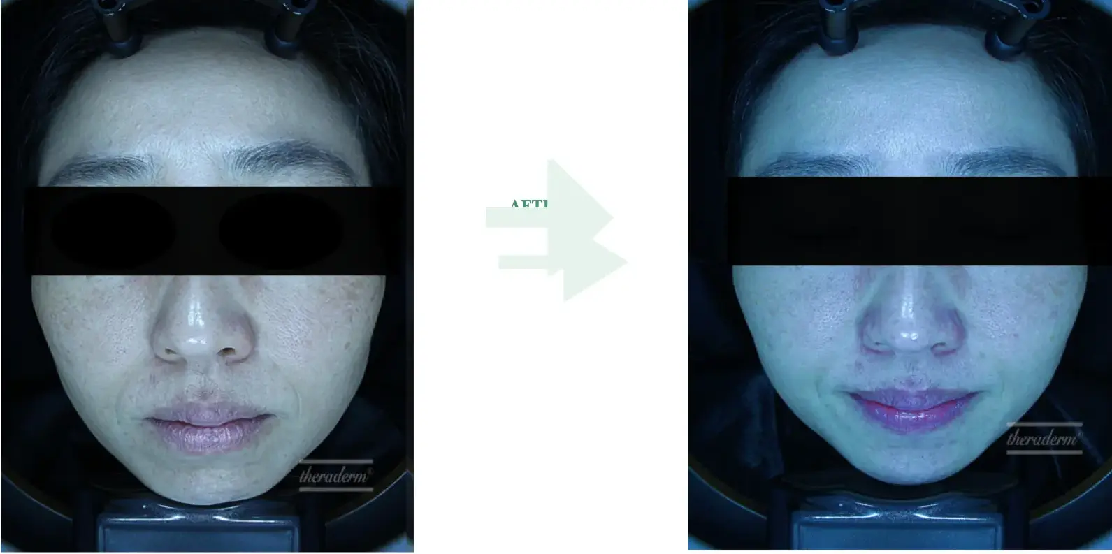 Before and after result 8 for Korean Peels